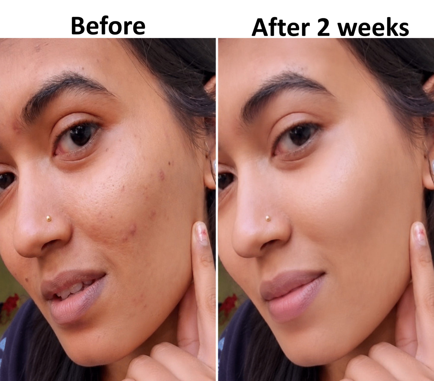 Before and after 2 weeks of using Renity Ageless Beauty Cream — reduced pimples and acne marks, skin looks glowing and fresh