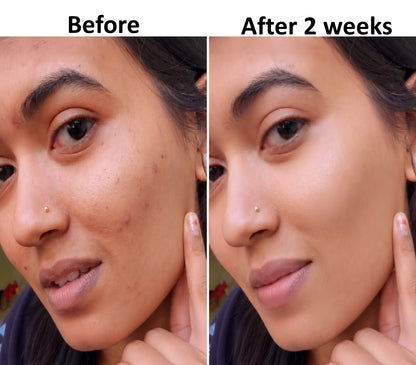Before and after 2 weeks of using Renity Ageless Beauty Cream — reduced pimples and acne marks, skin looks glowing and fresh