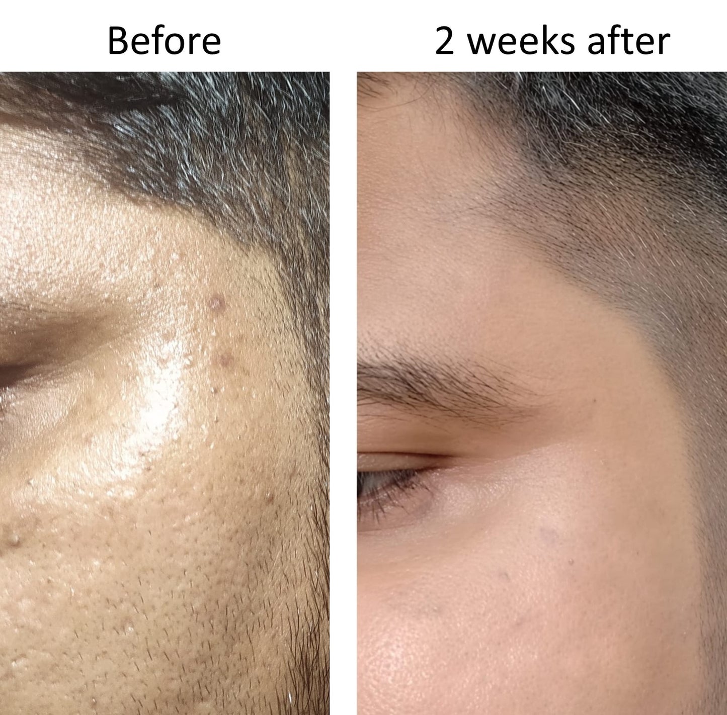 Before and after 2 weeks of using Renity Ageless Beauty Cream showing clearer, smoother skin